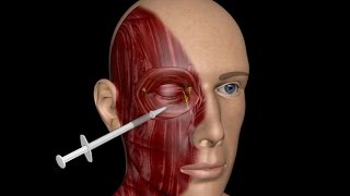 3D MEDICAL TRAINING PROGRAM  BLEPHAROSPASM TREATMENT [upl. by Akinet]