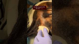 Hair Loss Due to Tight Hairstyles  Hair Transplant on Traction Alopecia [upl. by Wynnie]