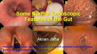 Some normal endoscopic features of the gut [upl. by Ahtelrac]