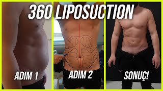 360 derece liposuction  Öncesi Sonrası ile Tüm Süreç [upl. by Llennod]