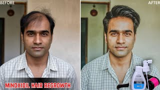 minoxidil hair regrowth results  derma roller hair regrowth results mintop minoxidil 5 hair growth [upl. by Edras]