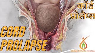 Cord Prolapse causes types occult clinicalmanifestation hindi ritikasnursingtutorials [upl. by Orelia]