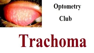 Trachoma [upl. by Erodasi]