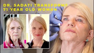 Dr Sadati Transforms 71 year old Woman with Lower Face and Neck Lift and Restylane Lyft Filler [upl. by Nodnelg]