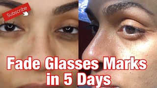 How I Removed My Glasses Marks In Only 5 Days  DIY Spot Treatment [upl. by Herzig]