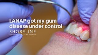 Treat periodontal disease with less pain Dr Urbanski explains the LANAP procedure [upl. by Digirb]