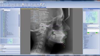 TIPS for making cephalometric analysis in Planmeca Romexis 35 and newer [upl. by Kraft]