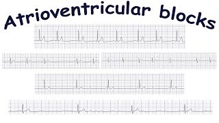 Atrioventricular blocks [upl. by Massey344]