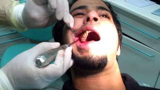 Third molar Extraction wisdom tooth [upl. by Eicyak]