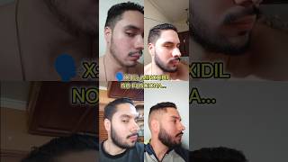 Seguimos con el minoxidil 🗿🧔🏻 minoxidil membersmark barba beard constancia sigma discipline [upl. by Aynotel]