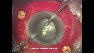 Endophthalmitis After Cataract Surgery Khaled A Shalaby MD [upl. by Samaria]