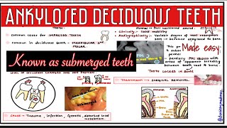 ANKYLOSED DECIDUOUS TEETH  SUBMERGED TEETH  Oral pathology [upl. by Clotilde]