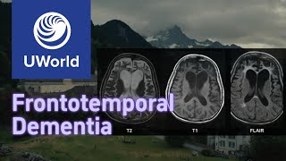 Frontotemporal Dementia vs Alzheimer Disease with Histology  UWorld USMLE MBBS [upl. by Modestine931]