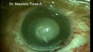 CATARACT SURGERY IN PHACOLYTIC GLAUCOMA  Dr Mauricio Turati Acosta [upl. by Enila]