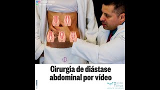 CIRURGIA DE DIÁSTASE POR VÍDEO [upl. by Mayne]