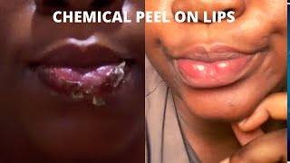 Chemical peel on lipschemical peeling treatmentglycolic acid peel on lips before ampafter [upl. by Cristie32]