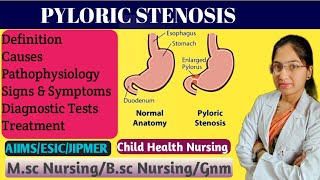 Pyloric Stenosis in Pediatric Nursing  Projectile Vomiting  Causes  Pathophysiology  Treatment [upl. by Aicemed]