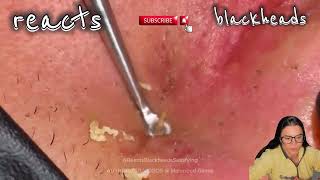 blackhead in ear blackhead in ear removal blackhead in earring hole blackhead in ear extraction [upl. by Gotthelf]