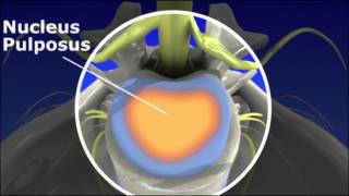 Herniated Disc  Pain Management [upl. by Accber]