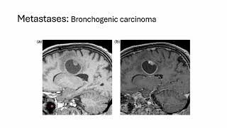 Diagnosing brain tumors can be a complex process [upl. by Childers]