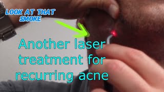 Laser treatment for acne A follow up [upl. by Colbert]