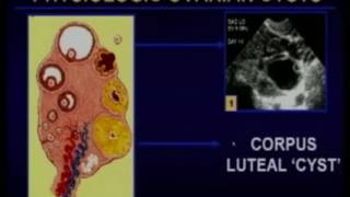 Sonographic Evaluation of the Ovary To Worry or not to Worry [upl. by Hairas272]