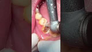 Tooth caries dentist dental viralvideo [upl. by Laure]