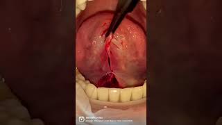 NEW🔥🔥🔥 Frenectomy  removal of a frenulum 🦷 Doctor Marta Siewert  Gutowska [upl. by Lavine450]