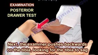 Posterior Drawer Test PCL Injury  Everything You Need To Know  Dr Nabil Ebraheim [upl. by Eittel]