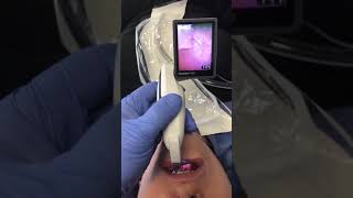 Video Laryngoscopy [upl. by Aizti]