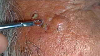 sac be spa blackheads elderly 2024  sac dep spa boy age blackheads 2024  sac be spa face today new [upl. by Cherise1]