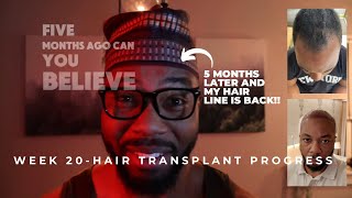 Week 20   month 5  Turkey Hair transplant Insane growth this month [upl. by Eixid]