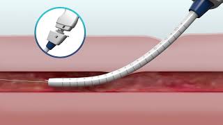 MANTA Vascular Closure Device Overview [upl. by Leandra]