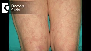 Purple lace type of discoloration on lower extremities signify Livedo Reticularis  Dr Nischal K [upl. by Winthorpe]