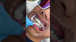 teeth whitening transformation 🦷 torontoteethwhitening teethwhitening [upl. by Dera]