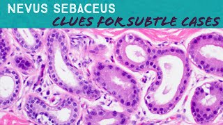 Nevus Sebaceus subtle clues vs classic Dermpath in 5Minutes dermatology pathology birthmark [upl. by Vale]