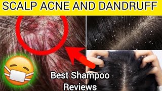 Dandruff amp Itching Shampoo Review – What Really Works [upl. by Tudor414]