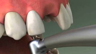 Dentist  Maryland Bridge Procedure [upl. by Schurman]