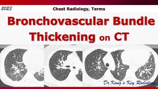 Bronchovascular bundle thickening on CT [upl. by Suirrad412]