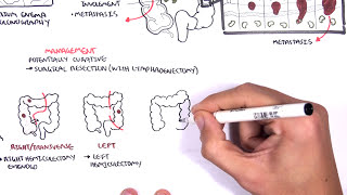 Colorectal Cancer  Overview [upl. by Arries]