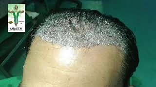 Hair Transplant in BhopalRs15hairgraft Call or WhatsApp 9222222409 [upl. by Prissie]