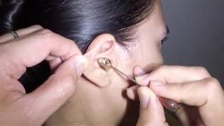 Womans Earwax Finally Removed after 25 Years [upl. by Oletha]