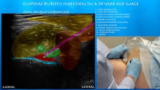 Ultrasound Guided Iliopsoas Bursts Injection by probeultrasound [upl. by Zetneuq]