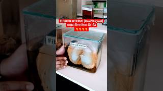 Fibroid uterus  बच्चेदानी की गाँठ । Uterine myoma [upl. by Ilac]