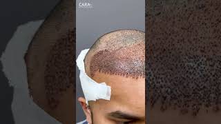 Experience WORLD CLASS Hair Transplant at Cara Clinic Mumbai [upl. by Dickey250]