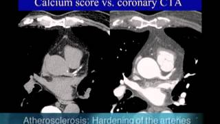 UCSF Radiology Calcium Scoring vs Coronary CTA Scan [upl. by Bedwell244]