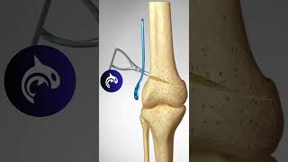 Distal Femoral Osteotomy of the Knee  3D animation knee kneepain orthopedics [upl. by Anyahs]