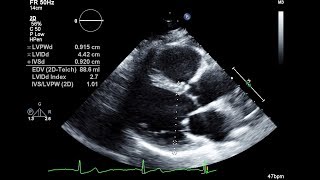 Routine Echocardiogram Protocol With Standard 2D Echo Images and Color Doppler [upl. by Uahc]