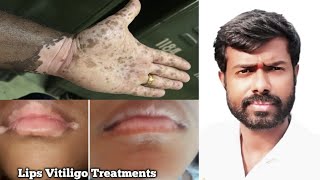 உதட்டில் உள்ளங்கையில் உள்ள வெண்புள்ளியை குணமாக்க முடியும்  lips vitiligo treatment awareness tamil [upl. by Moses796]