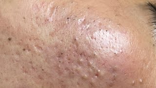 ACNE TREATMENT VU QUYNH MI  Blackheads On Boy Face 2024FULL [upl. by Rao]